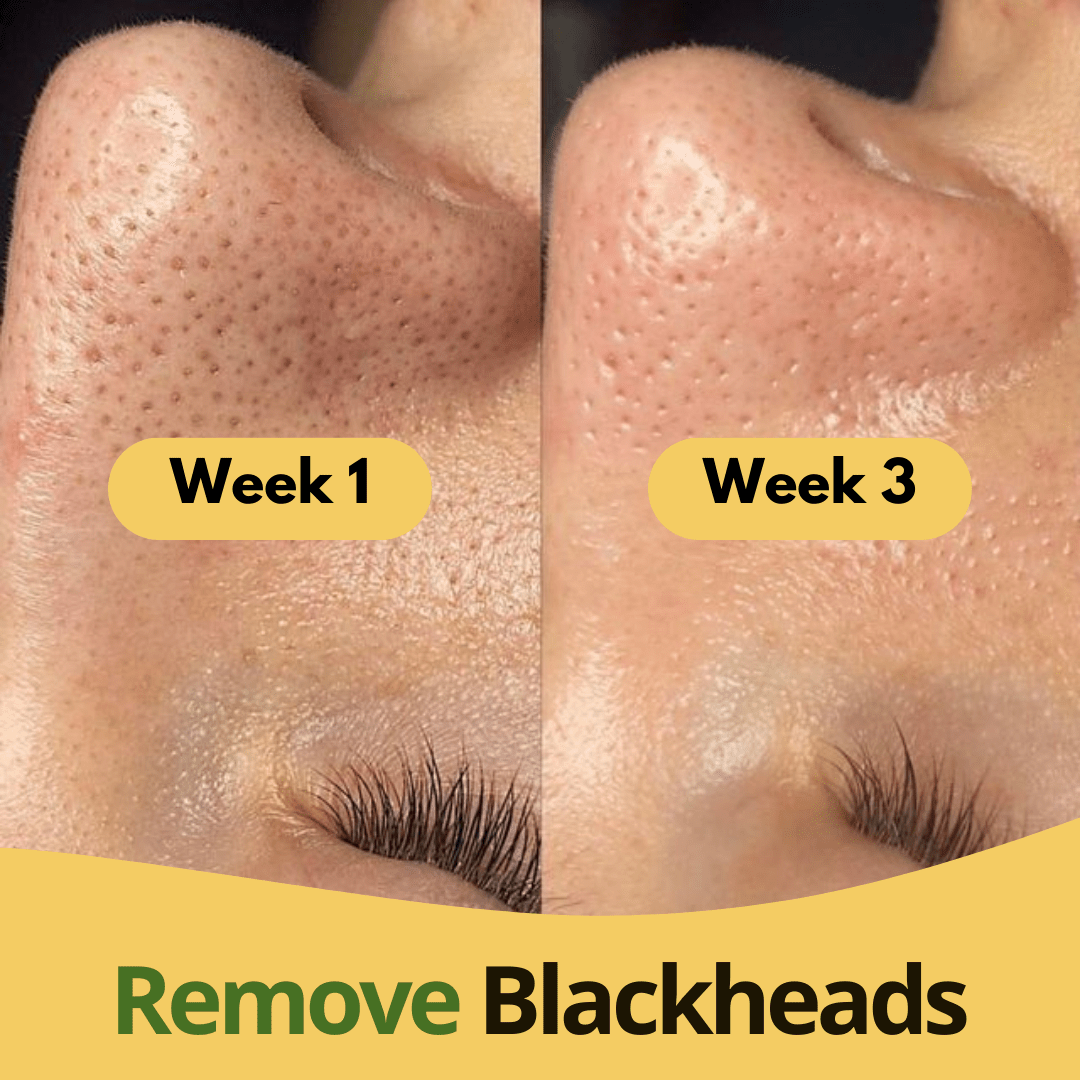 Turmeric & Kojic Acid Pads